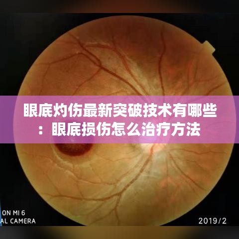 眼底灼伤最新突破技术有哪些：眼底损伤怎么治疗方法 