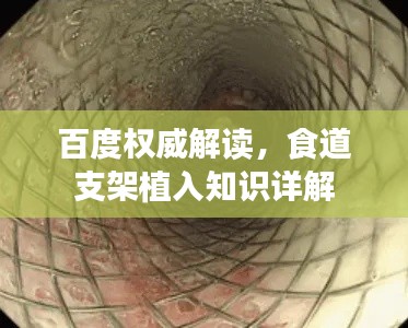 百度权威解读，食道支架植入知识详解